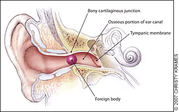 Common foreign bodies in the ear canal