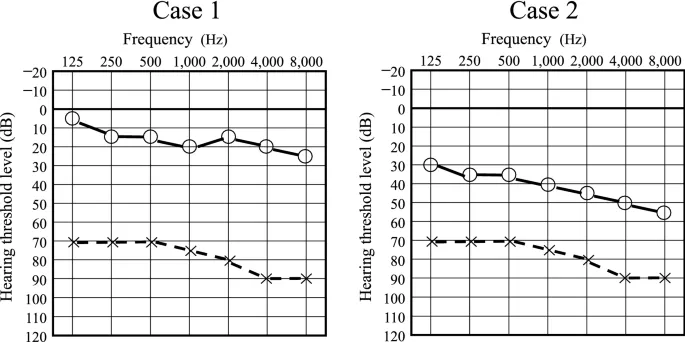 Audiograms showing sudden sensorineural hearing loss