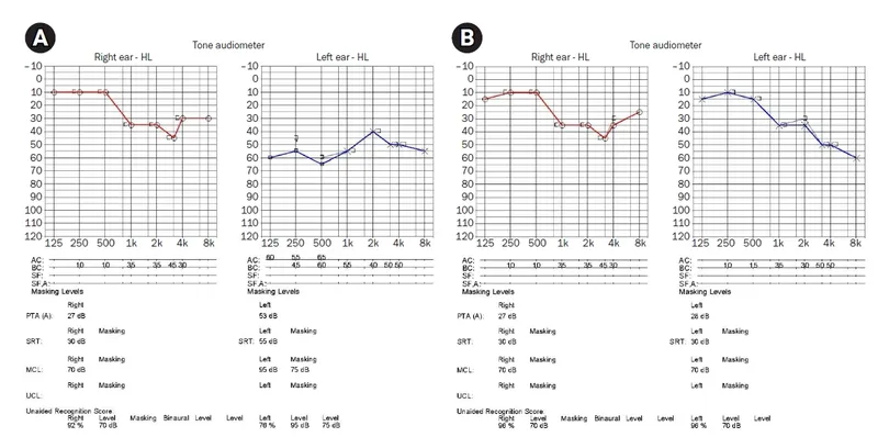 Audiograms showing sudden sensorineural hearing loss