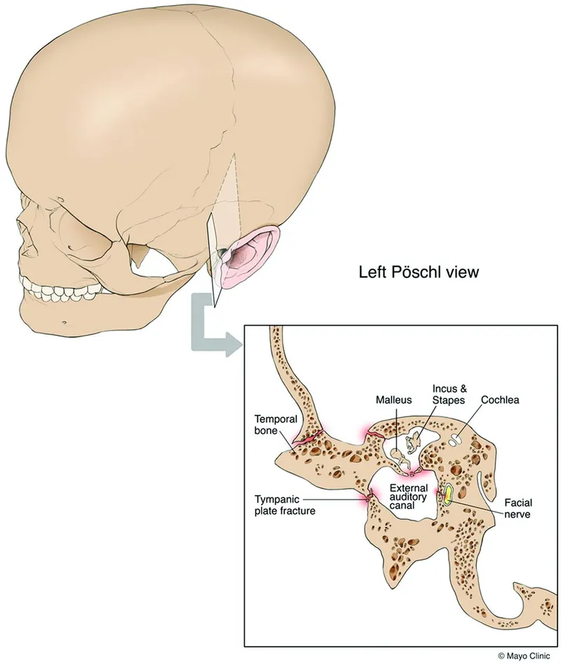Temporal Bone Fracture with Tympanic Plate Involvement