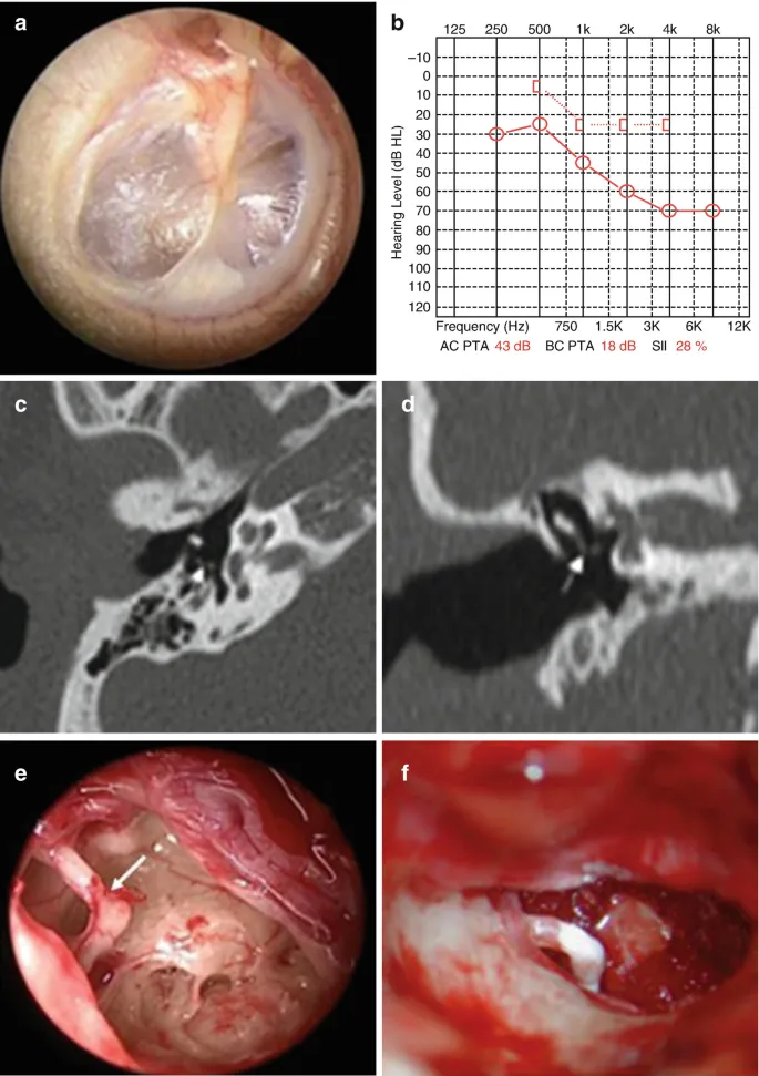 Audiogram, CT, and surgical views of ossicular disruption