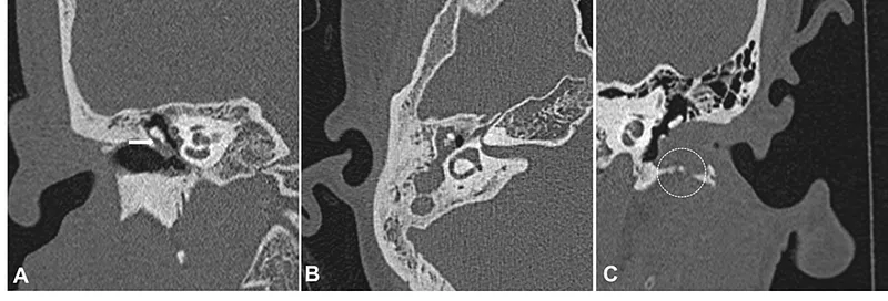 Axial HRCT: Left temporal bone cholesteatoma