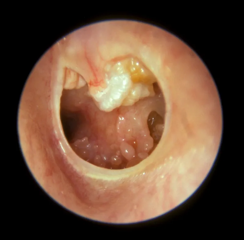 Otoscopic view of cholesteatoma
