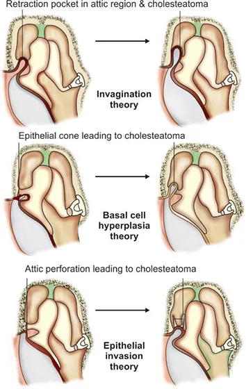 Cholesteatoma pathogenesis theories