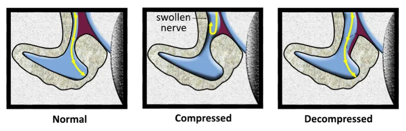 Facial nerve decompression diagram