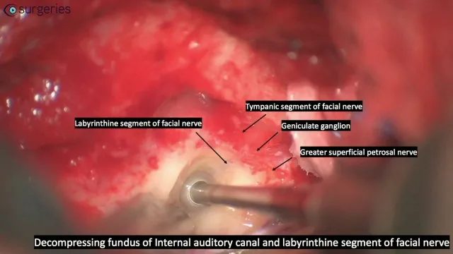 Facial nerve segments for decompression