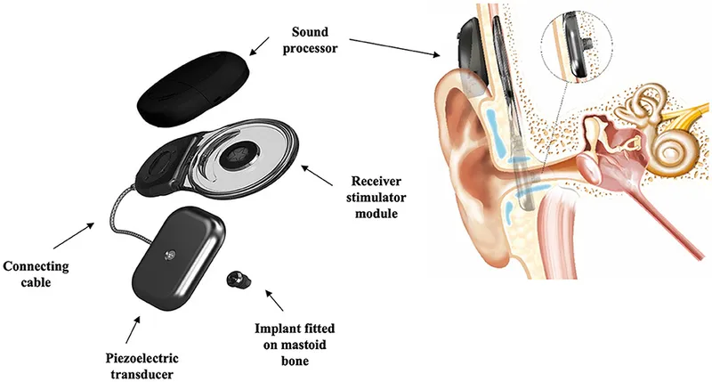 Piezoelectric transducer implant components and placement