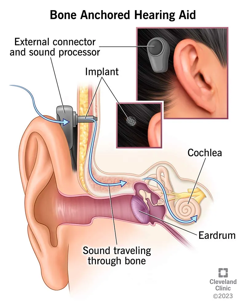 Bone Anchored Hearing Aid (BAHA) Diagram