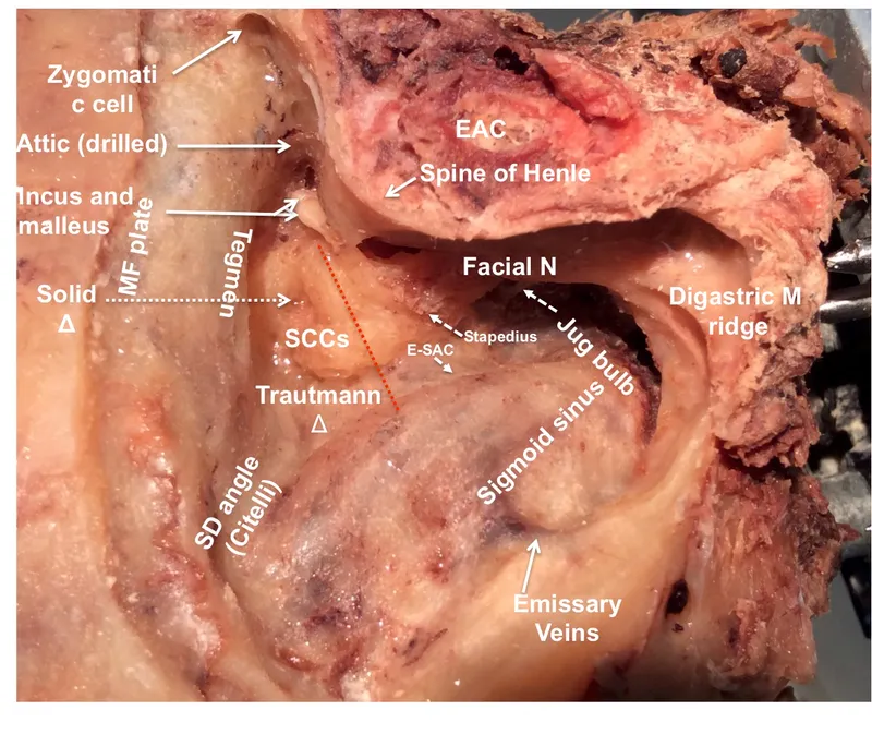 Mastoidectomy surgical landmarks and facial nerve