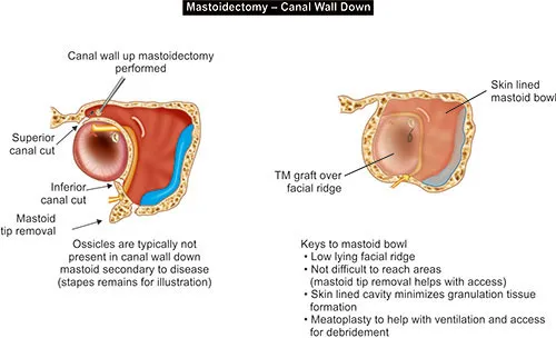 Canal Wall Up vs Down Mastoidectomy