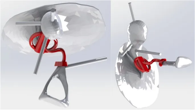 PORP and TORP prostheses in situ