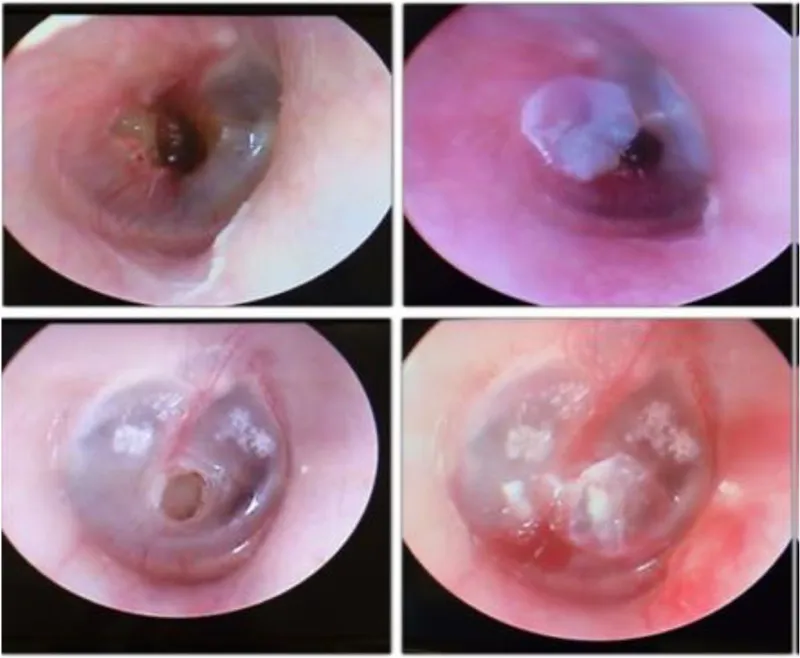 Otoscopic views of traumatic tympanic membrane perforations