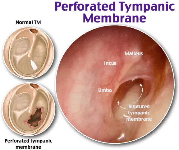 Perforated Tympanic Membrane: Otoscopic View vs. Diagrams