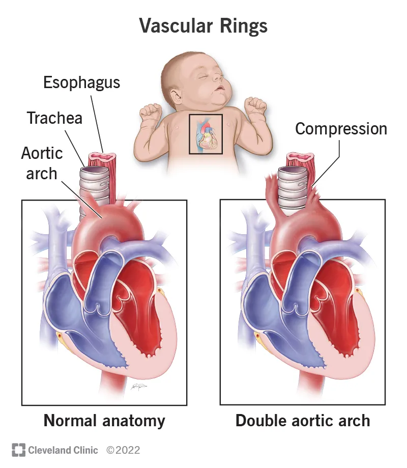 Vascular Rings: Normal vs. Double Aortic Arch