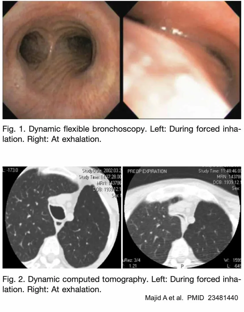 Dynamic CT of tracheal collapse in tracheomalacia