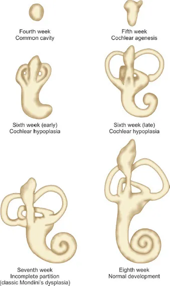 Cochlear Development and Anomalies