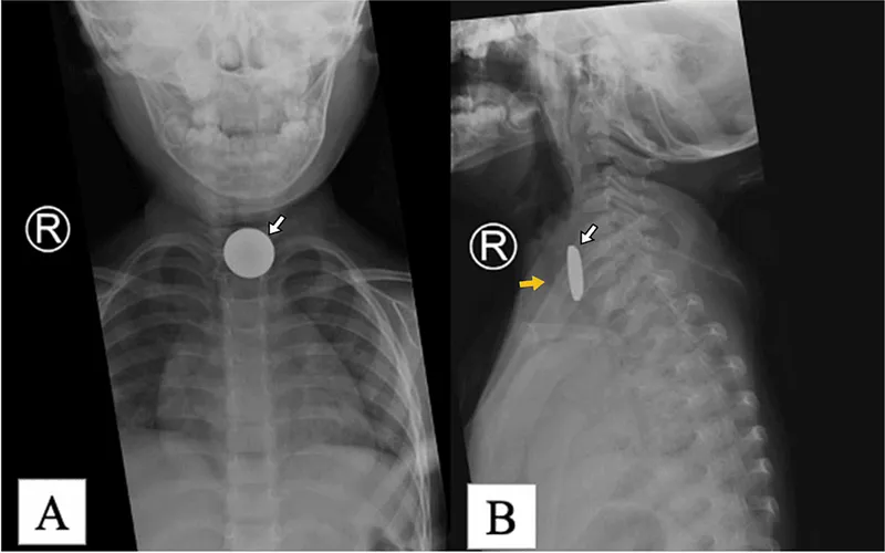 Coin in esophagus vs trachea X-ray comparison