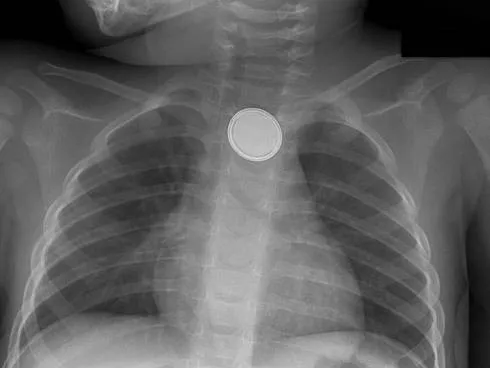 Coin in Esophagus X-ray
