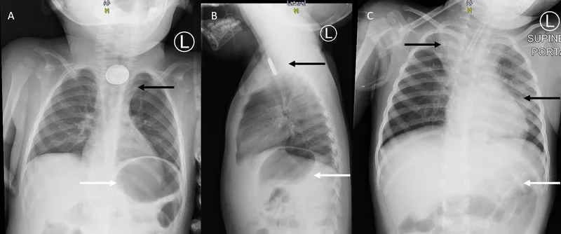 Pediatric Esophageal Button Battery X-ray Series