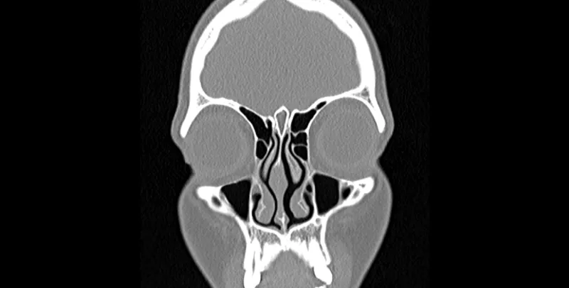 Coronal CT scan of pediatric sinusitis