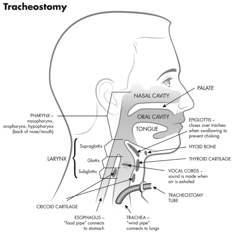 Pediatric tracheostomy surgical steps