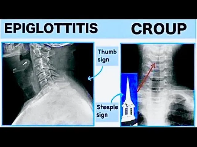 X-ray: Epiglottitis (thumb) vs Croup (steeple)