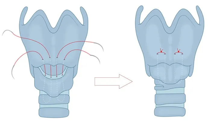 Cricothyroid Approximation for Voice Feminization