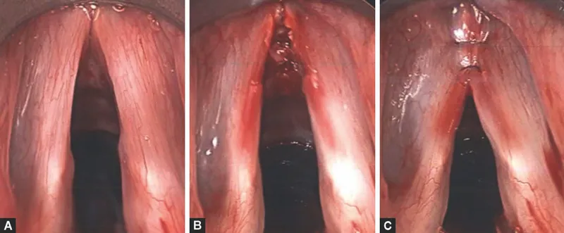 Type III Thyroplasty for Voice Masculinization