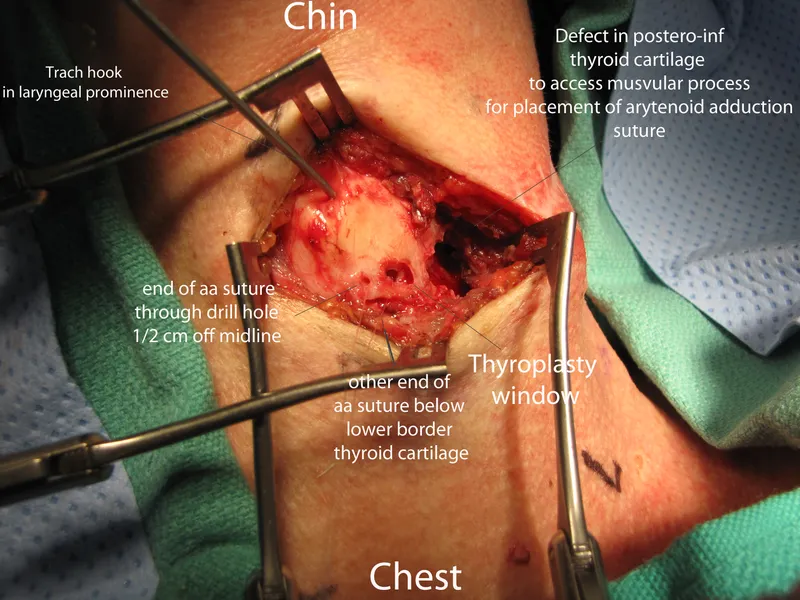 Arytenoid adduction suture placement
