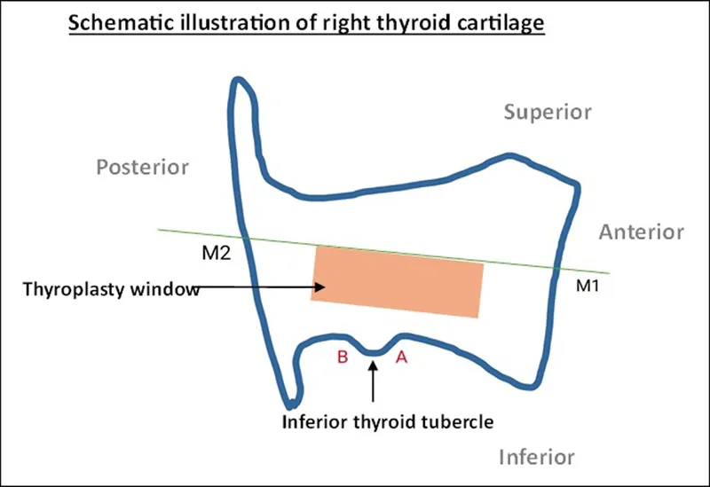 Thyroid cartilage with thyroplasty window