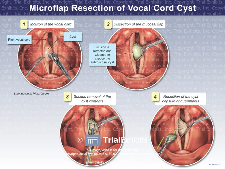 Laryngoscopic view of vocal cord cyst