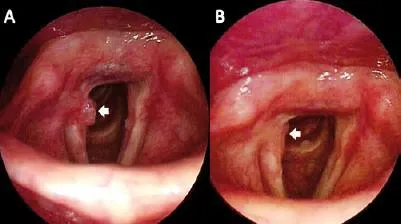 Endoscopic views: vocal fold nodule and polyp