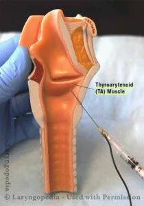Botox injection into the thyroarytenoid muscle