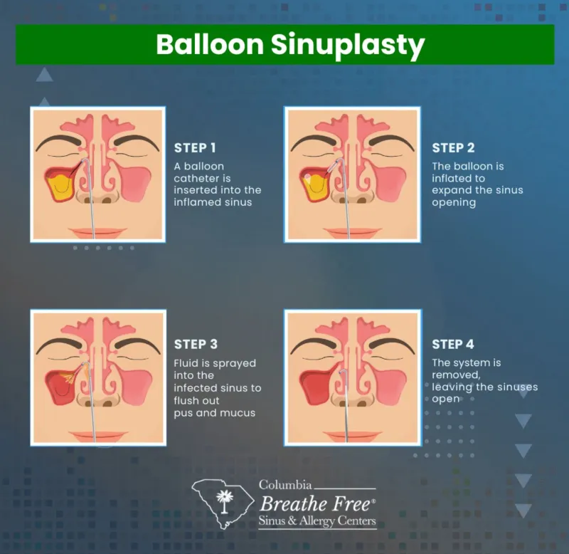 Balloon Sinuplasty Procedure Steps