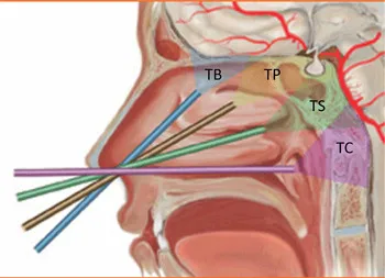 Sagittal view of skull base with EEA approach angles