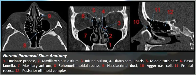 Coronal CT scan paranasal sinuses with anatomy labels