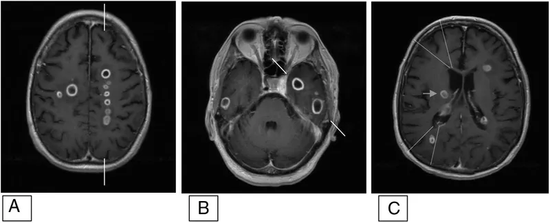 Axial MRI showing multiple brain abscesses