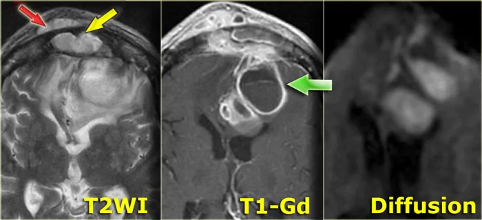 Brain abscess from sinusitis on MRI