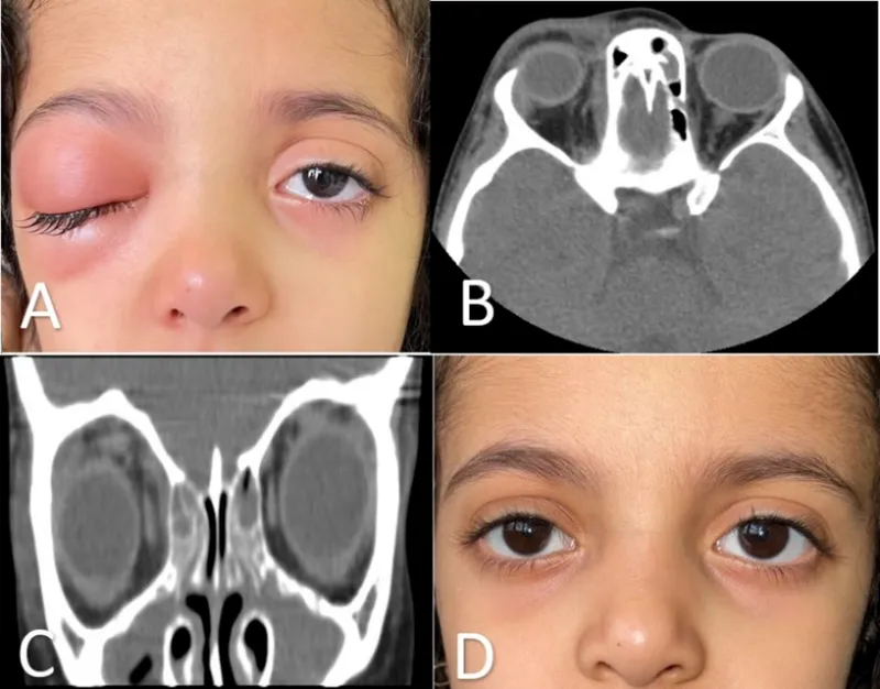 Orbital Complications of Sinusitis: Clinical & CT