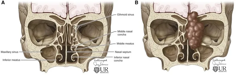 Coronal view of nasal anatomy and polyps