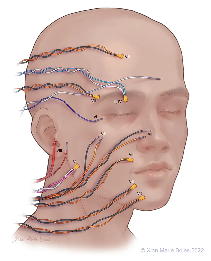 Intraoperative neuromonitoring for cranial nerves
