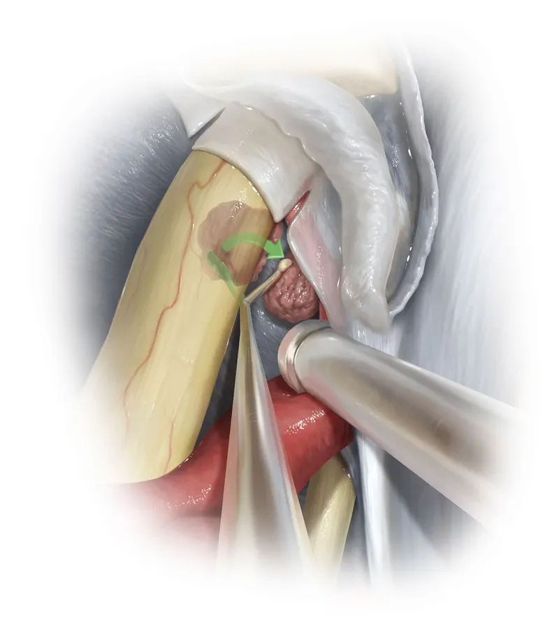 Pituitary adenoma removal near optic nerve