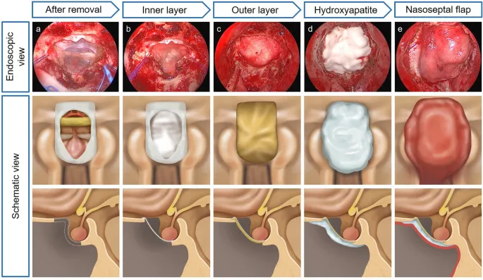 Endoscopic skull base repair steps