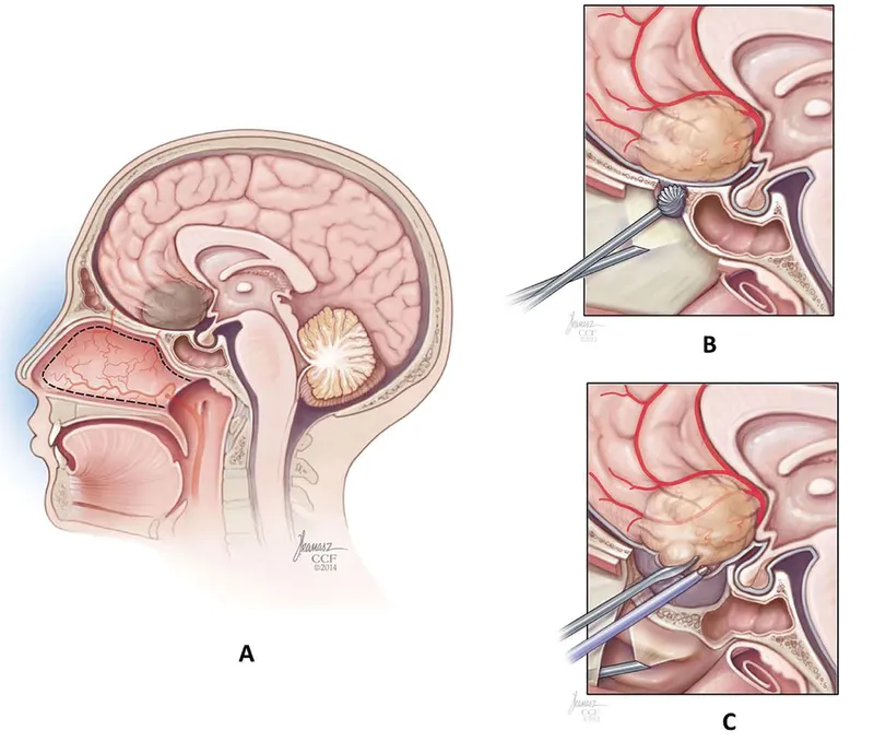 Endoscopic Skull Base Surgery Approach