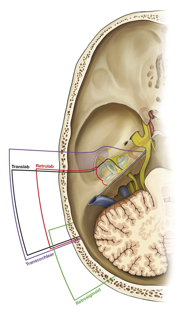 Lateral Skull Base Approaches Diagram