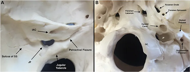 Lateral skull base anatomy with key foramina and structures