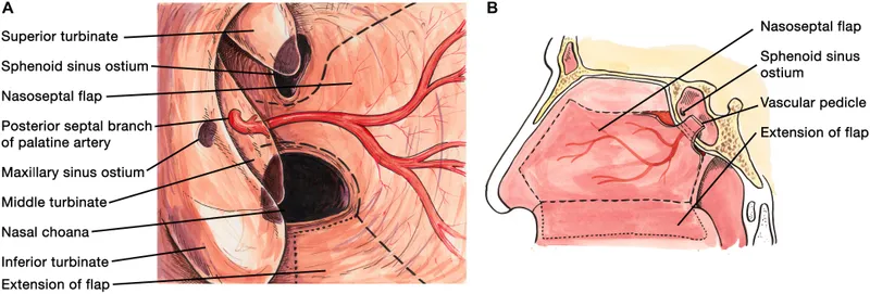 Nasoseptal flap harvesting and placement