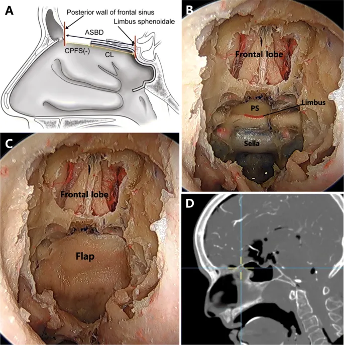 Skull Base Reconstruction: Flap Techniques & Anatomy