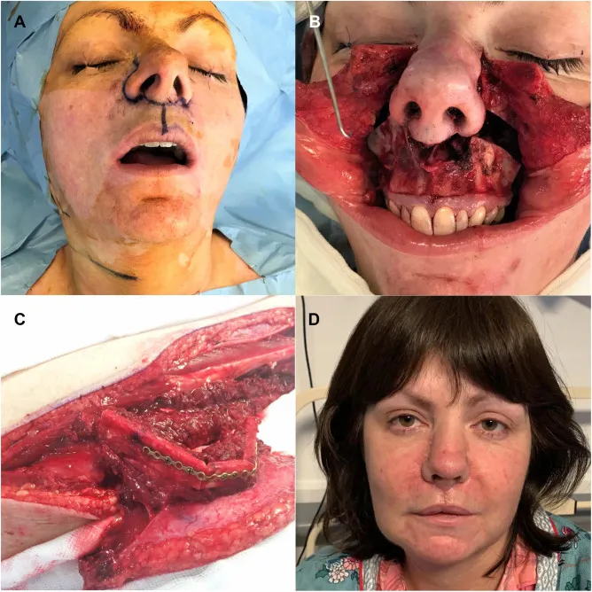 Skull Base Reconstruction with ALT Flap