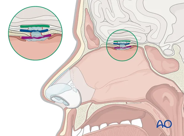 Underlay vs. Overlay Graft Technique for Skull Base Repair
